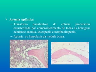 • Anemia Aplástica
– Transtorno quantitativo de células precursoras
caracterizada por comprometimento de todas as linhagens
celulares: anemia, leucopenia e trombocitopenia.
– Aplasia ou hipoplasia da medula óssea.
 