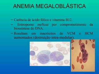 ANEMIA MEGALOBLÁSTICA
– Carência de ácido fólico e vitamina B12.
– Eritropoese ineficaz por comprometimento da
biossíntese do DNA.
– Resultam em macrócitos de VCM e HCM
aumentados (destruição intra-medular).
 