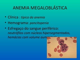 ANEMIA MEGALOBLÁSTICA
• Clínica : típica da anemia
• Hemograma: pancitopenia
• Esfregaço do sangue periférico:
neutrófilos com núcleos hipersegmentados,
hemácias com volume aumentado
 