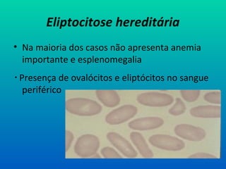 Eliptocitose hereditária
• Na maioria dos casos não apresenta anemia
importante e esplenomegalia
 Presença de ovalócitos e eliptócitos no sangue
periférico
 