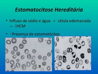 Estomatocitose Hereditária
• Influxo de sódio e água → célula edemaciada
→ HCM
•  Presença de estomatócitos
 