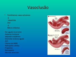 Vasoclusão
• Fenômenos vaso-oclusivos
↓
Isquemia
Dor
↓
Micro-infartos
Dor aguda recorrente
Asplenia funcional
Seqüestro esplênico
Síndrome torácica aguda
AVC
Úlceras de MMII
Nefropatia crônica
Priapismo
Retinopatia
Necrose avascular
 