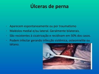 Úlceras de perna
- Aparecem espontaneamente ou por traumatismo
- Maléolos medial e/ou lateral. Geralmente bilaterais.
- São resistentes à cicatrização e recidivam em 50% dos casos.
- Podem infectar gerando infecção sistêmica, osteomielite ou
tétano.
 