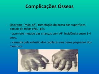 Complicações Ósseas
- Síndrome “mão-pé”: tumefação dolorosa das superfícies
dorsais de mãos e/ou pés.
- acomete metade das crianças com AF. Incidência entre 1-4
anos.
- causada pela oclusão dos capilares nos ossos pequenos dos
membros.
 