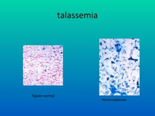talassemia
Fígado normal
Hemossiderose
 