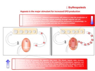 | Erythropoiesis
Keypoint!
In chronic states of anaemia the opposite may occur. The chronic hypoxic state increases
production of EPO. This leads to an increase in the proportion of erythroblasts, expansion and
eventually fatty deposition within the bone marrow. During childhood when the growth plates are
still present, this expansion can lead to bone deformities such as frontal bossing. This is seen in
chronic haemolysis such as thalassaemia.
Keypoint!
Chronic renal disease / bilateral nephrectomy will reduce or stop the production of
EPO. It’s absence or reduction causes anaemia through reduced red cell
production. Anaemia due to EPO deficiency will be normocytic in morphology; i.e.
the red cell will be a normal shape and size but reduced in number.
Hypoxia is the major stimulant for increased EPO production
Kidney
Bone marrow
erythropoietin
Erythroid
precursors
Stem
cells
Kidney
Bone marrow
erythropoietin
Erythroid
precursors
Stem
cells
 