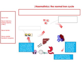 |Haematinics: the normal iron cycle
Iron deficiency can be identified best by assessing the appearances of the red cells on a
blood film. Iron indices in a blood sample are helpful to confirm a lack of iron. In order to
interpret these indices, it is vital to understand how the body handles iron …..
Erythroid bone
marrow
(normoblasts) Reticuloendothelial system;
Spleen & macrophages
Duodenum
Serum
transferrin
Fe
Red blood
cells
Liver
Iron is a key constituent of haemoglobin (60-70% of total body iron
is stored here) and it’s availability is essential for erythropoiesis. In
iron deficiency, there are more divisions of red cells during
erythropoiesis than normal. As a result the red cells are smaller
(microcytic) and have a reduced haemoglobin content
(hypochromic).
2. Iron is then attached
to a protein, transferrin
in the serum (plasma),
where it is transported
to the bone marrow for
haemoglobin synthesis.
1. Iron is absorbed from the
small intestine in the ferrous
state (Fe2+
; approx. 1mg/day).
3. Dying red cells
are recycled by
macrophages in
the spleen and
iron is recycled
into the plasma
for further use.
Soluble transferrin receptors,
sTfR are on the red cell surface.
These can be measured and
are increased in iron deficiency.
An iron deficiency
profile.
Serum Iron: Reduced
Serum total iron-
binding capacity
(TIBC): Increased- the
body works hard to bind
free iron.
Serum ferritin:
Reduced-since iron
stores are low
Serum soluble
transferrin receptors:
Increased-since red
cells attempt to absorb
more iron.
In iron deficient states, bone marrow
iron is reduced.
Some iron binds to
apoferritin to form
ferritin, a storage
compound.
 