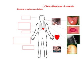 | Clinical features of anemia
General symptoms and signs
General Symptoms
Weakness and
lethargy
Shortness of
breath:
particularly on
exercise.
Headaches
Palpitations
Confusion and symptoms
of cardiac failure in
elderly
Some specific signsGeneral Signs
 