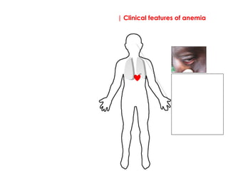 | Clinical features of anemia
Signs:
Pallor of mucous 
membranes (most 
common sign). This is a 
general sign.  
Beware: pallor is quite 
subjective and NOT a 
reliable clinical sign.  Be 
careful not to exclude 
anaemia on the basis of 
absence of pallor alone
 