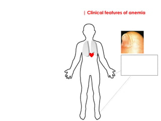 | Clinical features of anemia
Signs:
Nail bed; demonstrating 
koilonychia (spoon-
shaped nails).  This is 
specific to iron 
deficiency.
 
