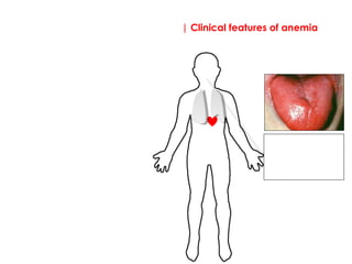 | Clinical features of anemia
Signs
Atrophic glossitis; red
large swollen tongue.
This is seen in both
vitamin B12 and folate
deficiency.
 