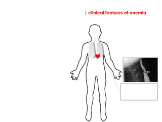 | clinical features of anemia
Signs
Dysphagia: pharyngeal
web (Paterson-Kelly
syndrome). This occurs
in iron deficiency.
 