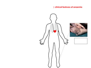 | clinical features of anaemia
Signs
Peripheral
oedema. A
general sign.
 