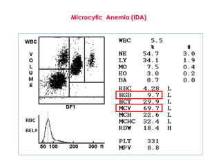 Microcytic Anemia (IDA)
 