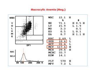 Macrocytic Anemia (Meg.):
 