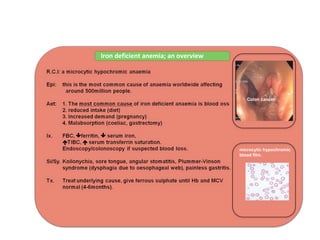 Iron deficient anemia; an overview
Colon cancer
microcytic hypochromic
blood film.
 
