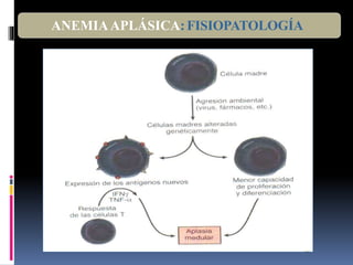 ANEMIAAPLÁSICA:FISIOPATOLOGÍA
 