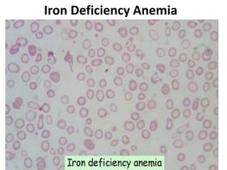 Iron Deficiency Anemia
 