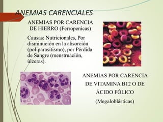 ANEMIAS CARENCIALES
ANEMIAS POR CARENCIA
DE HIERRO (Ferropenicas)
Causas: Nutricionales, Por
disminución en la absorción
(poliparasitismo), por Pérdida
de Sangre (menstruación,
úlceras).
ANEMIAS POR CARENCIA
DE VITAMINA B12 O DE
ÁCIDO FÓLICO
(Megaloblásticas)
 