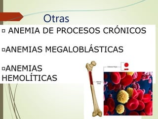 Otras
Anemias.
ANEMIA DE PROCESOS CRÓNICOS
ANEMIAS MEGALOBLÁSTICAS
ANEMIAS
HEMOLÍTICAS
 