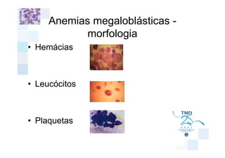 Anemias megaloblásticas -
            morfologia
• Hemácias



• Leucócitos



• Plaquetas
 