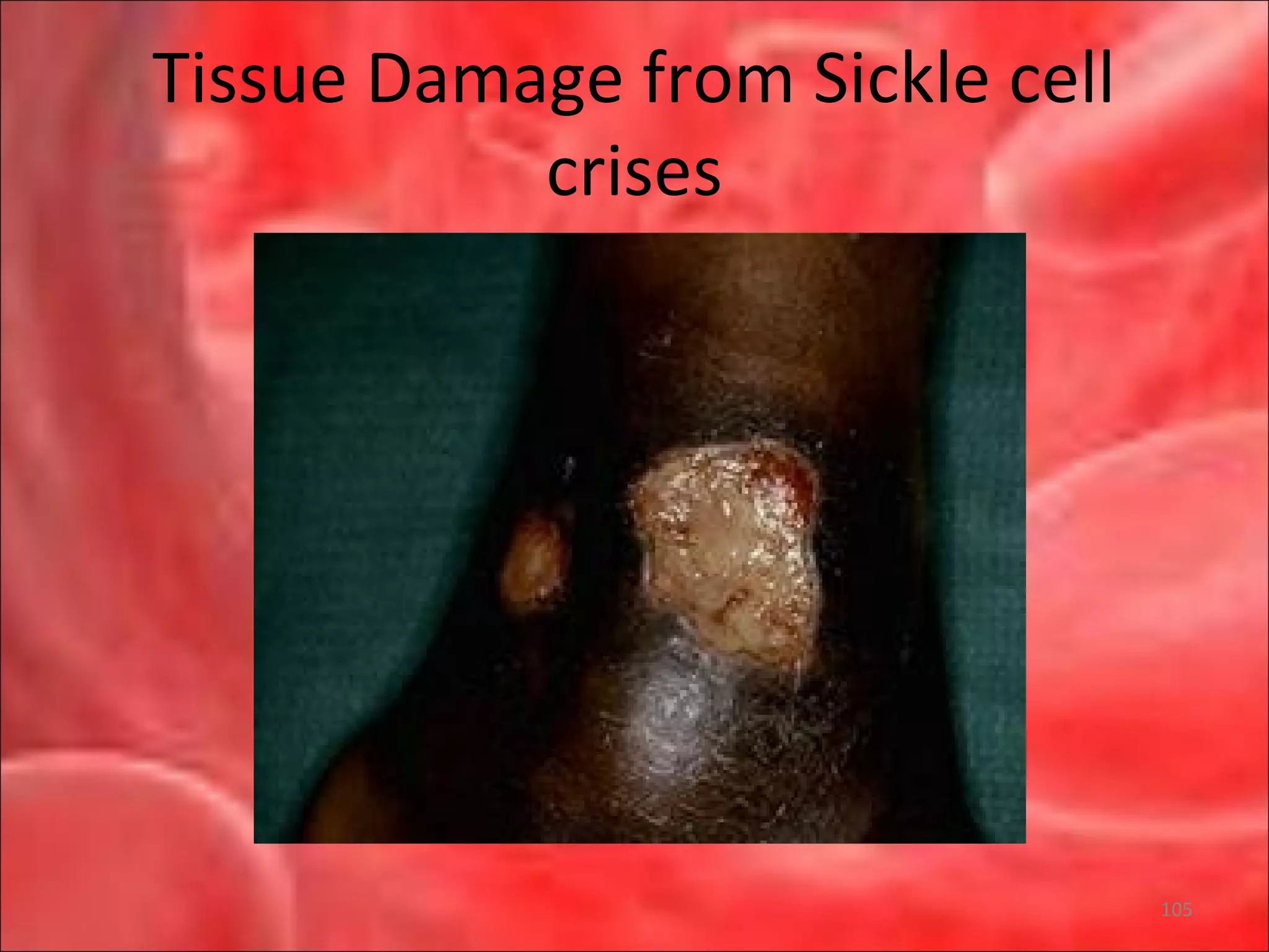 Tissue Damage from Sickle cell
crises
105
 