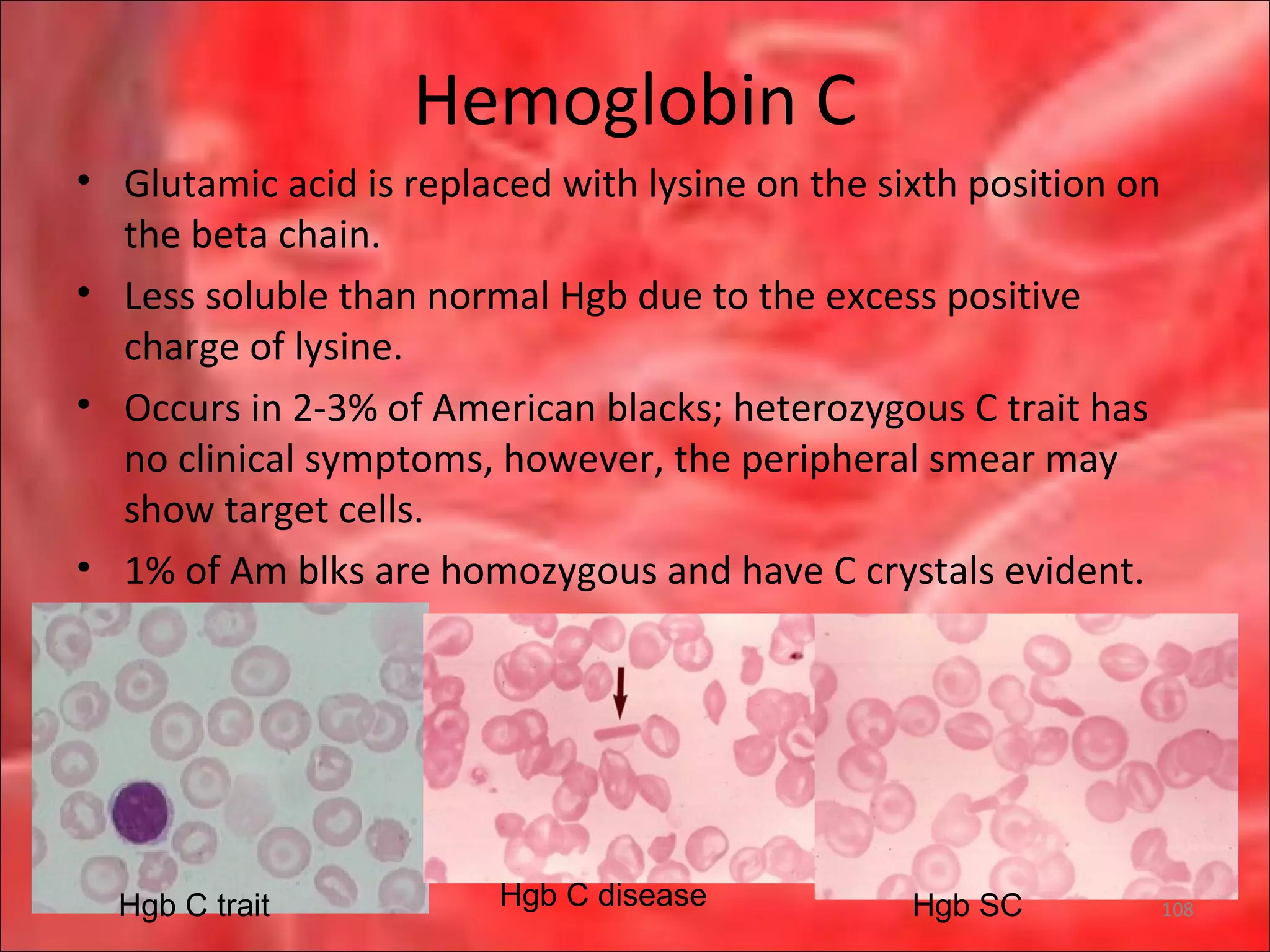 Hemoglobin C
• Glutamic acid is replaced with lysine on the sixth position on
the beta chain.
• Less soluble than normal Hgb due to the excess positive
charge of lysine.
• Occurs in 2-3% of American blacks; heterozygous C trait has
no clinical symptoms, however, the peripheral smear may
show target cells.
• 1% of Am blks are homozygous and have C crystals evident.
Hgb C trait Hgb C disease Hgb SC 108
 