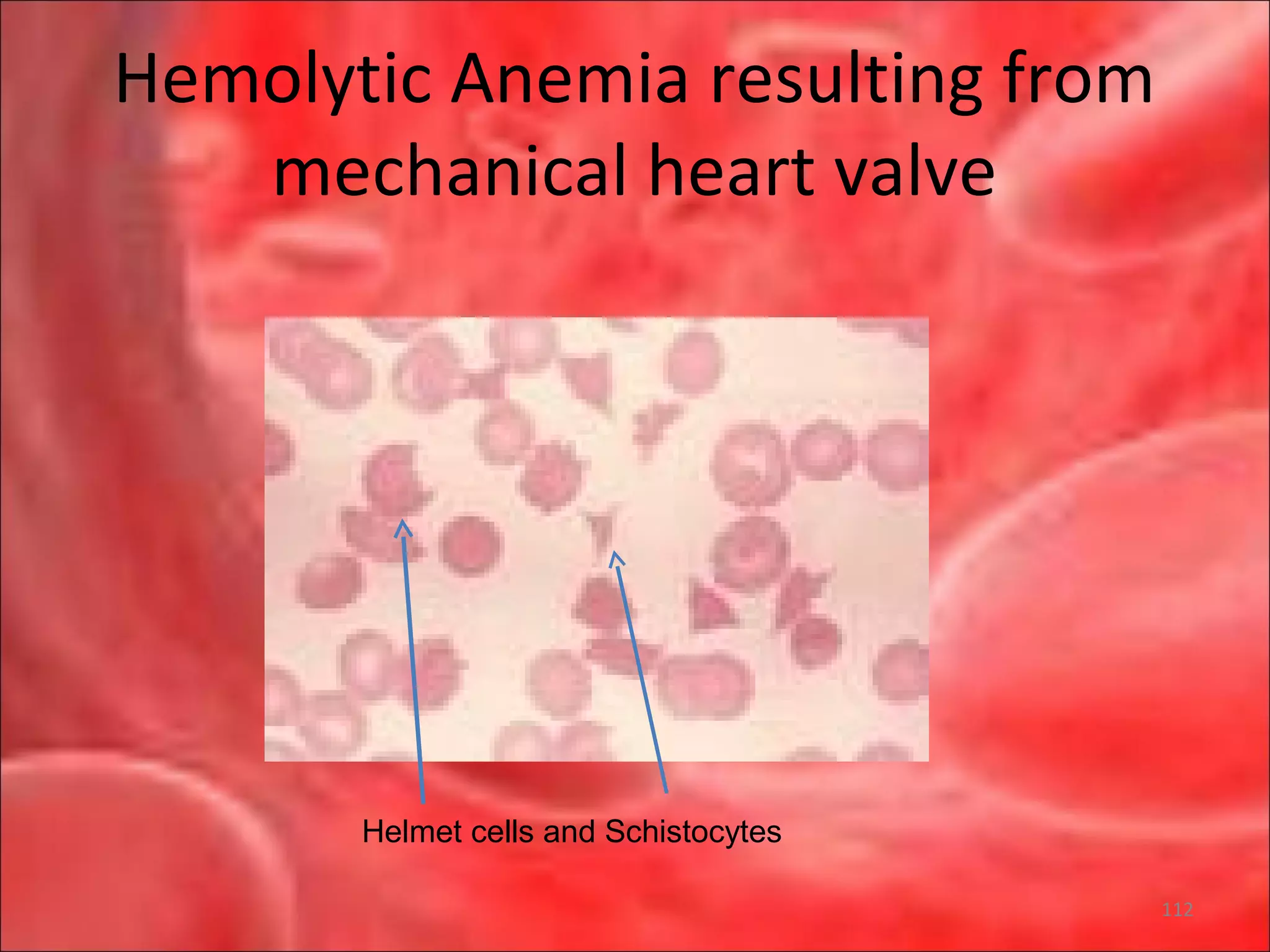 Hemolytic Anemia resulting from
mechanical heart valve
Helmet cells and Schistocytes
112
 