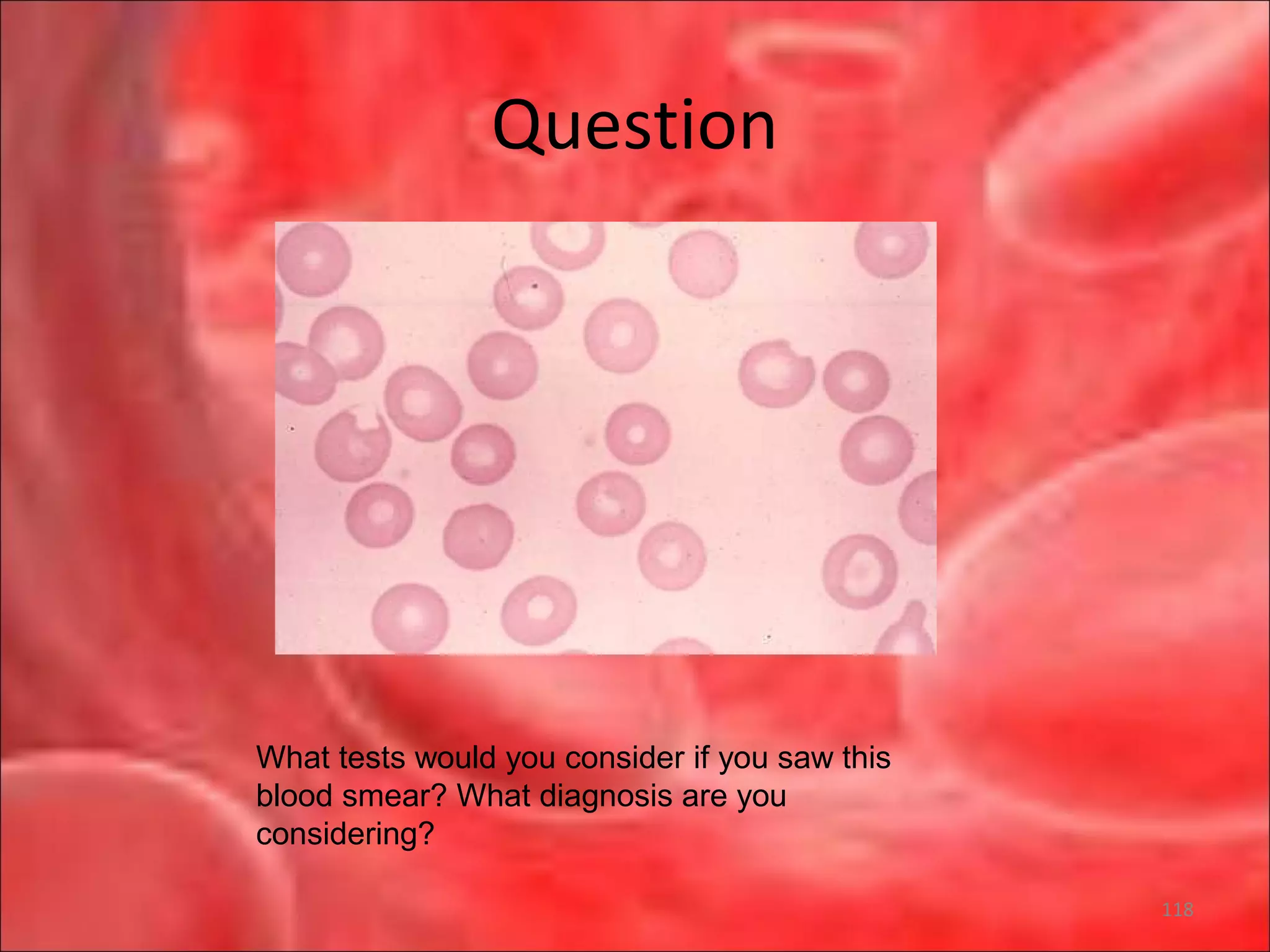 Question
What tests would you consider if you saw this
blood smear? What diagnosis are you
considering?
118
 
