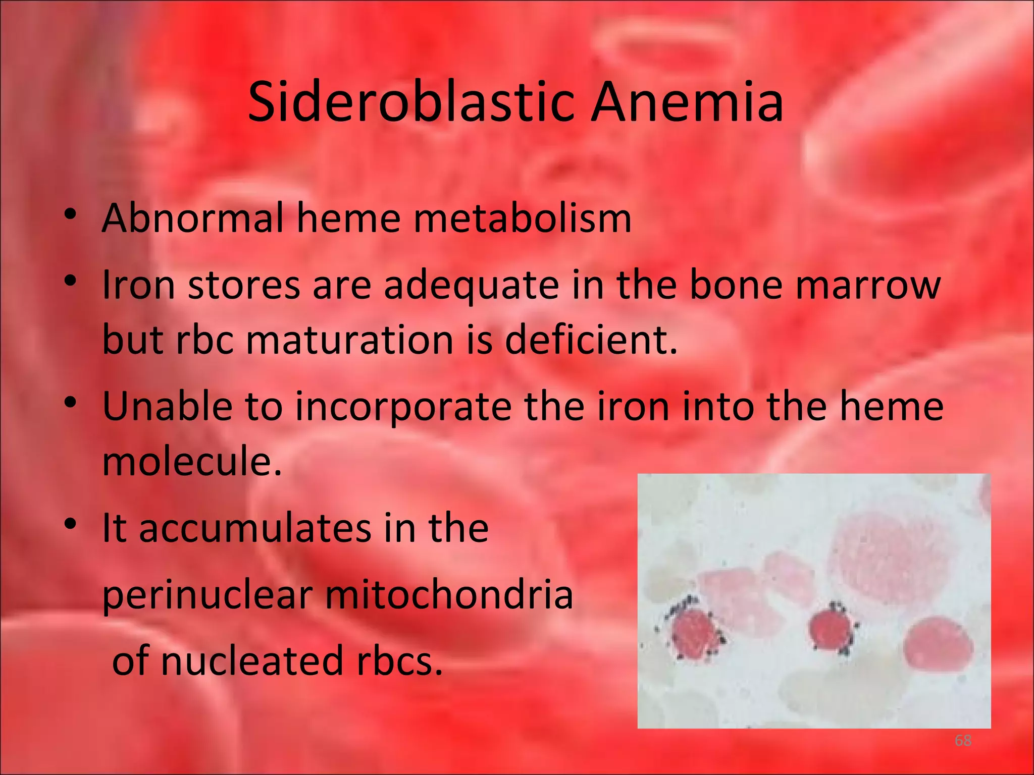 Sideroblastic Anemia
• Abnormal heme metabolism
• Iron stores are adequate in the bone marrow
but rbc maturation is deficient.
• Unable to incorporate the iron into the heme
molecule.
• It accumulates in the
perinuclear mitochondria
of nucleated rbcs.
68
 