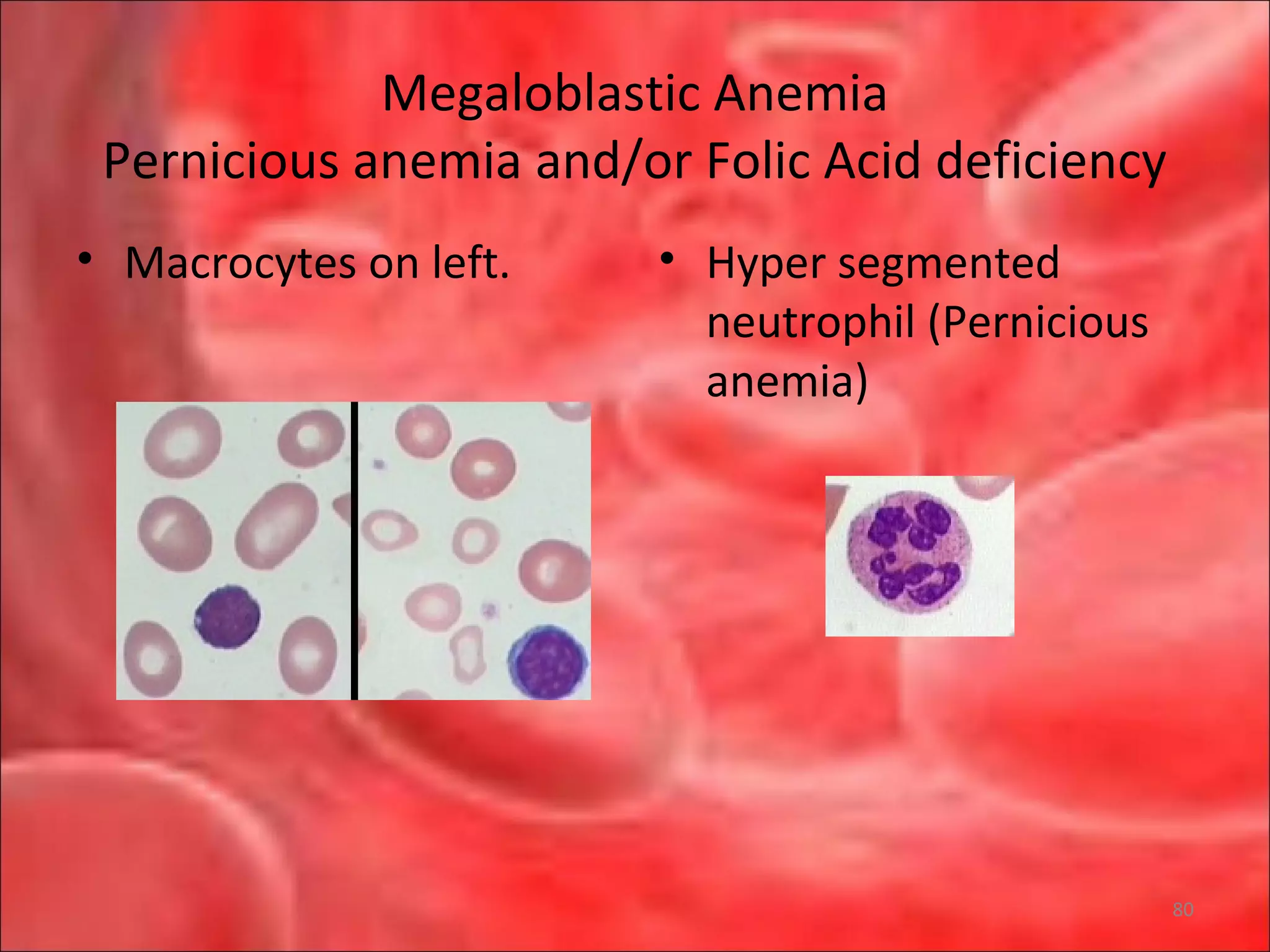 Megaloblastic Anemia
Pernicious anemia and/or Folic Acid deficiency
• Macrocytes on left. • Hyper segmented
neutrophil (Pernicious
anemia)
80
 
