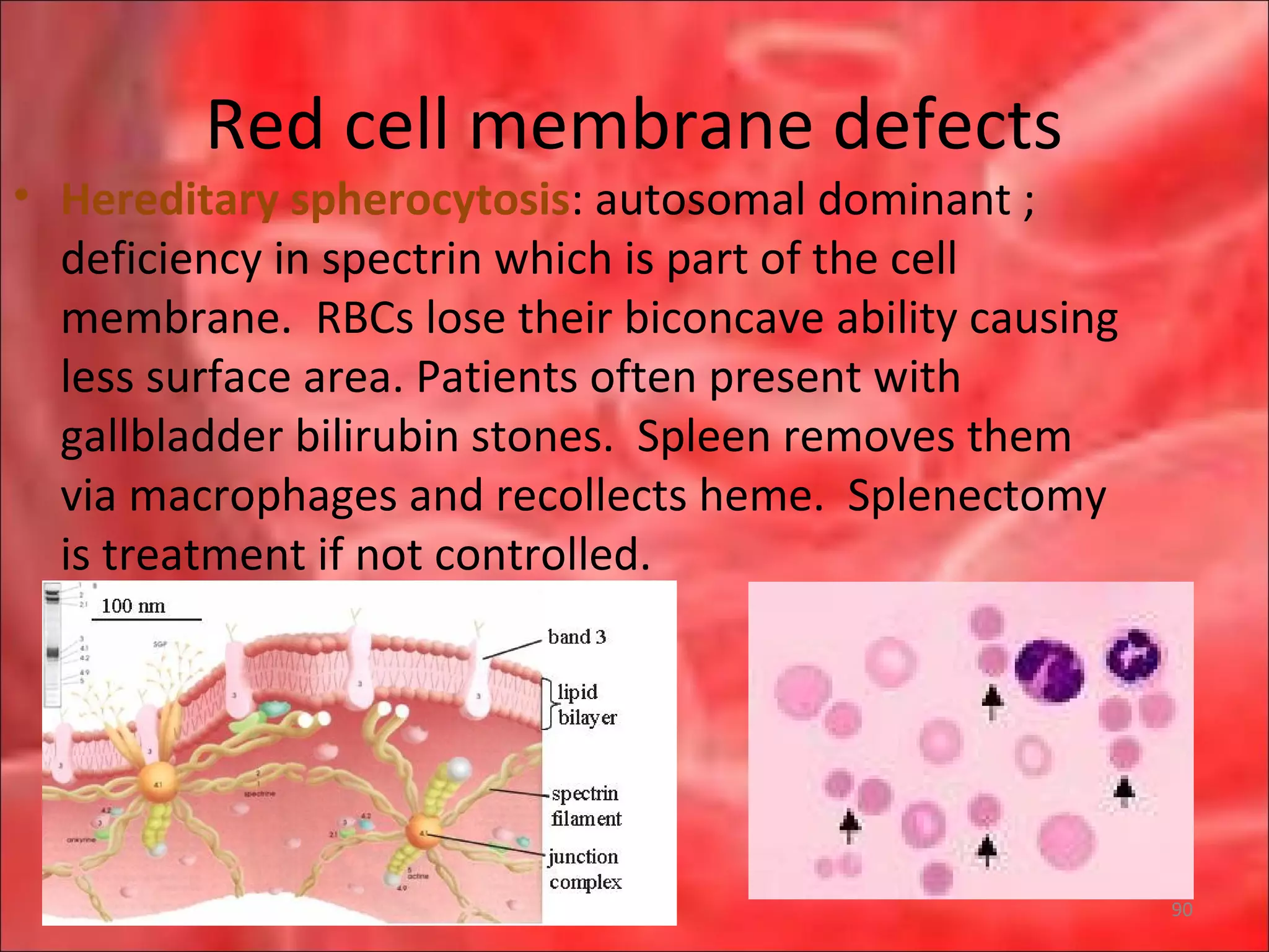 Red cell membrane defects
• Hereditary spherocytosis: autosomal dominant ;
deficiency in spectrin which is part of the cell
membrane. RBCs lose their biconcave ability causing
less surface area. Patients often present with
gallbladder bilirubin stones. Spleen removes them
via macrophages and recollects heme. Splenectomy
is treatment if not controlled.
90
 