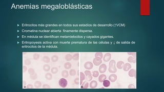 Anemias megaloblásticas
 Eritrocitos más grandes en todos sus estadíos de desarrollo (↑VCM)
 Cromatina nuclear abierta finamente dispersa.
 En médula se identifican metamielocitos y cayados gigantes.
 Eritropoyesis activa con muerte prematura de las células y ↓ de salida de
eritrocitos de la médula.
 
