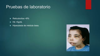 Pruebas de laboratorio
 Reticulocitos <8%
 Hb <5g/dL
 Hiperplasia de médula ósea.
 