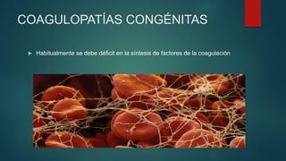  Habitualmente se debe déficit en la síntesis de factores de la coagulación
COAGULOPATÍAS CONGÉNITAS
 