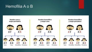  Deficiencia de los factores VIII (A) o IX (B)
Hemofilia A o B
 