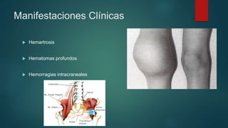  Hemartrosis
 Hematomas profundos
 Hemorragias intracraneales
Manifestaciones Clínicas
 
