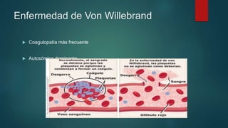 Coagulopatía más frecuente
 Autosómica dominante
Enfermedad de Von Willebrand
 