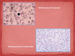 Deficiencia de Fe severa
Deficiencia de Fe intermedia
 