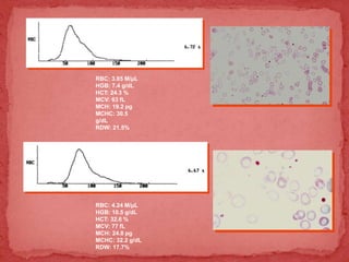 RBC: 3.85 M/µL
HGB: 7.4 g/dL
HCT: 24.3 %
MCV: 63 fL
MCH: 19.2 pg
MCHC: 30.5
g/dL
RDW: 21.5%
RBC: 4.24 M/µL
HGB: 10.5 g/dL
HCT: 32.6 %
MCV: 77 fL
MCH: 24.8 pg
MCHC: 32.2 g/dL
RDW: 17.7%
 