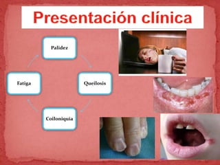 Palidez
Queilosis
Coiloniquia
Fatiga
 