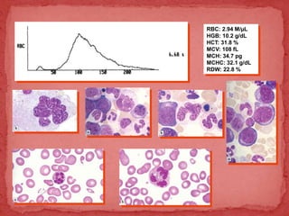 RBC: 2.94 M/µL
HGB: 10.2 g/dL
HCT: 31.8 %
MCV: 108 fL
MCH: 34.7 pg
MCHC: 32.1 g/dL
RDW: 22.8 %
 