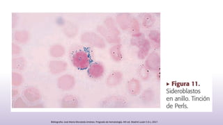 Bibliografia: José María Moraleda Jiménez. Pregrado de hematología. 4th ed. Madrid Luzán 5 D.L; 2017.
 