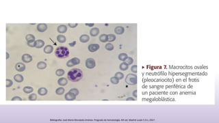 Bibliografia: José María Moraleda Jiménez. Pregrado de hematología. 4th ed. Madrid Luzán 5 D.L; 2017.
 
