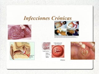 Infecciones Crónicas 
 