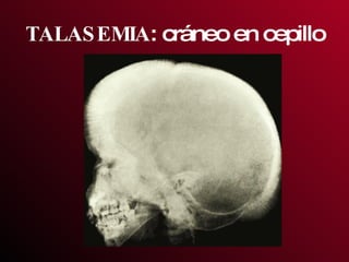 TALASEMIA : cráneo en cepillo 
