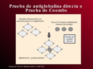 Prueba de antiglobulina directa o  Prueba de Coombs Tomado de Torres G. Medicine 2004; 9: 1269-1276 