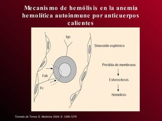 Mecanismo de hemólisis en la anemia hemolítica autoinmune por anticuerpos calientes Tomado de Torres G. Medicine 2004; 9: 1269-1276 
