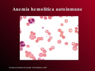 Anemia hemolítica autoinmune Tomado de Goldman & Ausiello. Cecil Medicine. 2007 