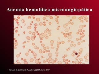 Anemia hemolítica microangiopática Tomado de Goldman & Ausiello.  Cecil  Medicine. 2007 